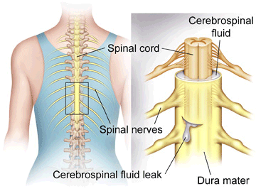 leaking spinal fluid